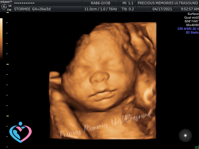 3d ultrasound 32 weeks